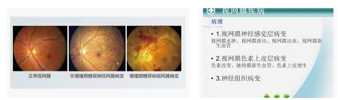 視網膜病變 視網膜病變